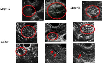 Imaging of Fibrosis in Chronic Pancreatitis